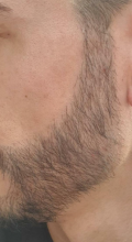 beard-transplant