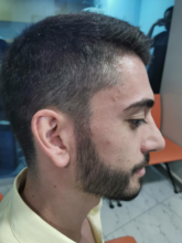 beard-transplant