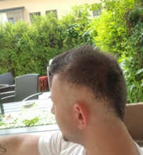 hair-transplant-izmir