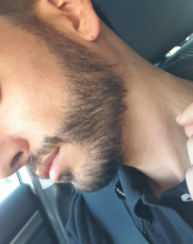 beard-transplant