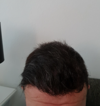 hair-transplant-izmir
