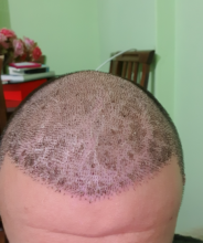 hair-transplant-izmir