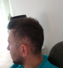 hair-transplant-izmir