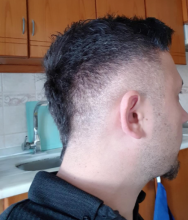 hair-transplant-izmir