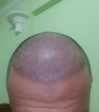 hair-transplant-izmir