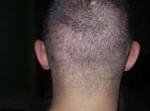 hair-transplant-izmir