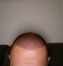 hair-transplant-izmir