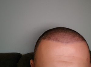 hair-transplant-izmir