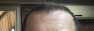 arenamed-4800-grafts