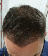 asmed-5040-grafts