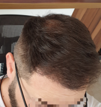 asmed-5040-grafts