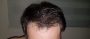 asmed-5040-grafts