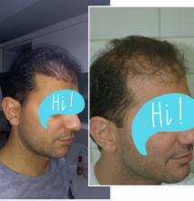 beard-hairtransplant