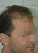 beard-hairtransplant