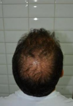 beard-hairtransplant