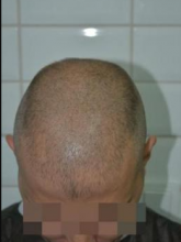 beard-hairtransplant