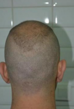 beard-hairtransplant