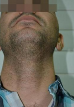 beard-hairtransplant