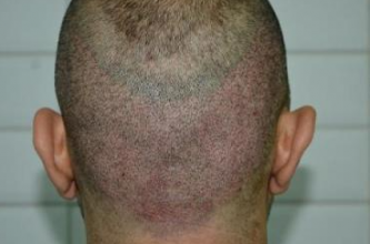 beard-hairtransplant