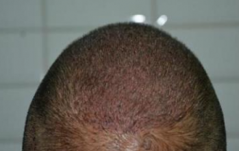 beard-hairtransplant