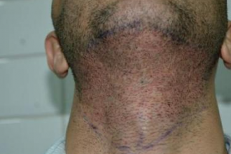 beard-hairtransplant
