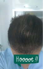 beard-hairtransplant
