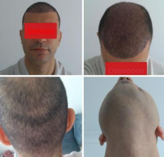 beard-hairtransplant