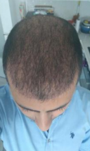 beard-hairtransplant