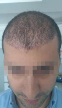 beard-hairtransplant