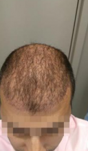 beard-hairtransplant