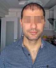 beard-hairtransplant