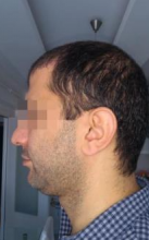 beard-hairtransplant