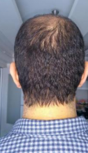 beard-hairtransplant