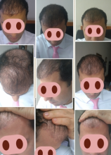 beard-hairtransplant