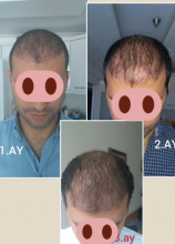beard-hairtransplant