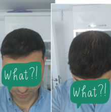 beard-hairtransplant