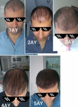 beard-hairtransplant