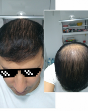 beard-hairtransplant