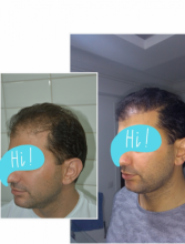 beard-hairtransplant