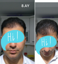 beard-hairtransplant