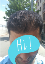 beard-hairtransplant