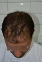 beard-hairtransplant