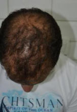 beard-hairtransplant