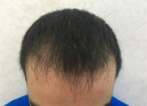 dr-kul-3100-grafts