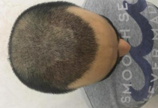 dr-kul-3100-grafts