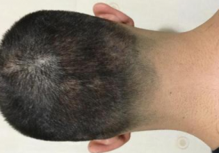dr-kul-3100-grafts