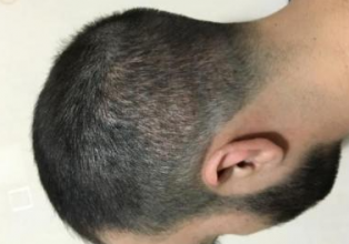 dr-kul-3100-grafts