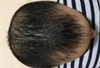 dr-kul-3100-grafts