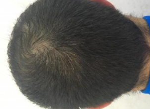 dr-kul-3100-grafts