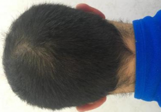 dr-kul-3100-grafts